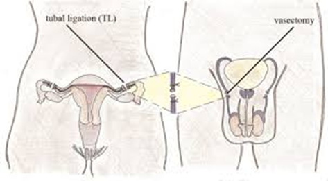 permanent contraceptive